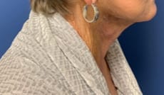 Facelift Before & After Patient #1690