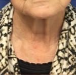 Facelift Before & After Patient #1690