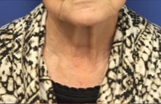 Facelift Before & After Patient #1690