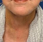 Facelift Before & After Patient #1690
