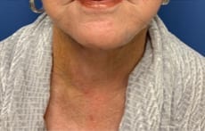 Facelift Before & After Patient #1690