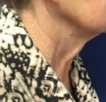 Facelift Before & After Patient #1690