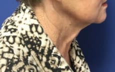 Facelift Before & After Patient #1690