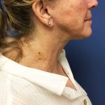 Facelift Before & After Patient #1695