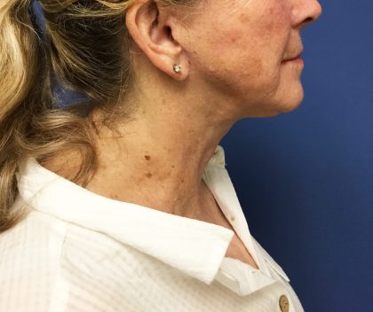 Facelift Before & After Patient #1695