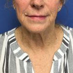 Facelift Before & After Patient #1695