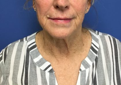 Facelift Before & After Patient #1695