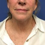 Facelift Before & After Patient #1695