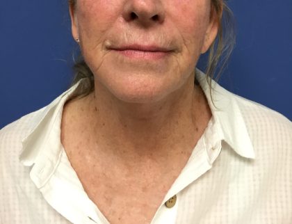 Facelift Before & After Patient #1695