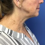 Facelift Before & After Patient #1695