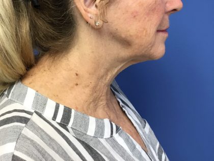 Facelift Before & After Patient #1695
