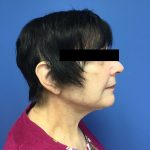 Facelift Before & After Patient #1700