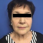 Facelift Before & After Patient #1700