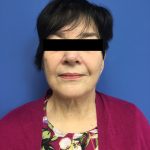 Facelift Before & After Patient #1700