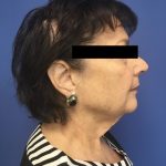 Facelift Before & After Patient #1700