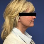 Facelift Before & After Patient #1705