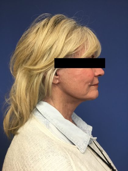 Facelift Before & After Patient #1705