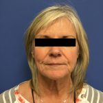 Facelift Before & After Patient #1705