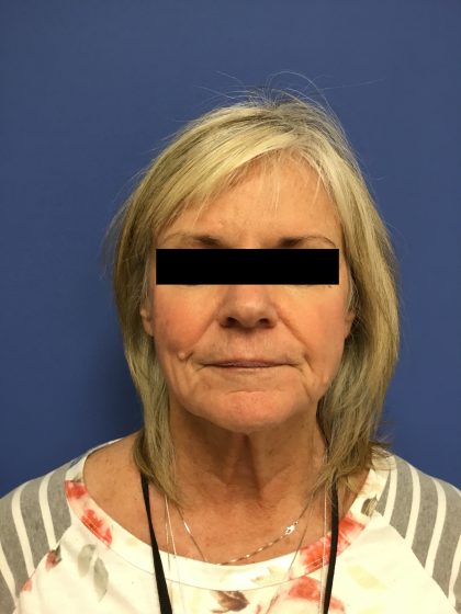 Facelift Before & After Patient #1705