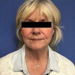 Facelift Before & After Patient #1705