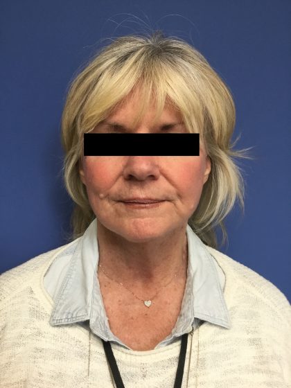 Facelift Before & After Patient #1705