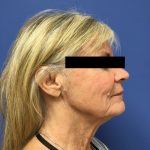Facelift Before & After Patient #1705