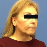 Facelift Before & After Patient #1710