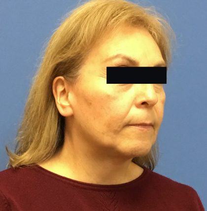Facelift Before & After Patient #1710