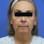 Facelift Before & After Patient #1710