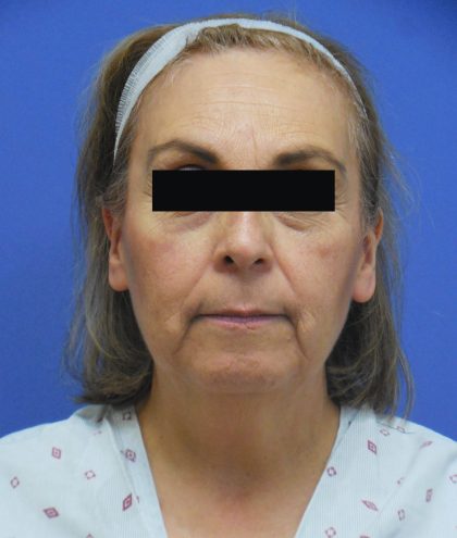 Facelift Before & After Patient #1710