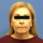 Facelift Before & After Patient #1710