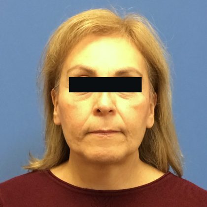 Facelift Before & After Patient #1710