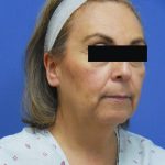 Facelift Before & After Patient #1710