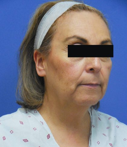 Facelift Before & After Patient #1710