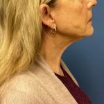 Facelift Before & After Patient #1715