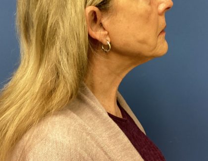 Facelift Before & After Patient #1715
