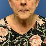 Facelift Before & After Patient #1715