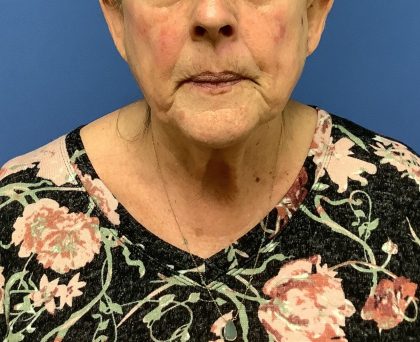 Facelift Before & After Patient #1715