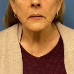 Facelift Before & After Patient #1715