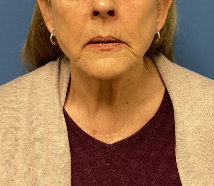 Facelift Before & After Patient #1715