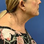Facelift Before & After Patient #1715