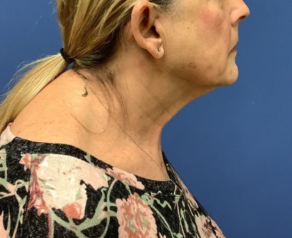 Facelift Before & After Patient #1715