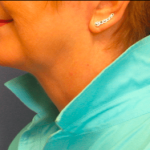 Facelift Before & After Patient #1720