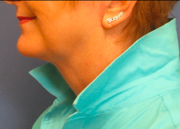 Facelift Before & After Patient #1720