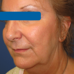 Facelift Before & After Patient #1720