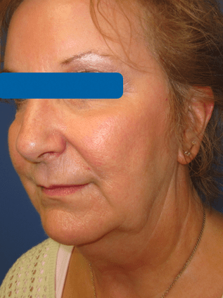 Facelift Before & After Patient #1720