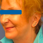 Facelift Before & After Patient #1720