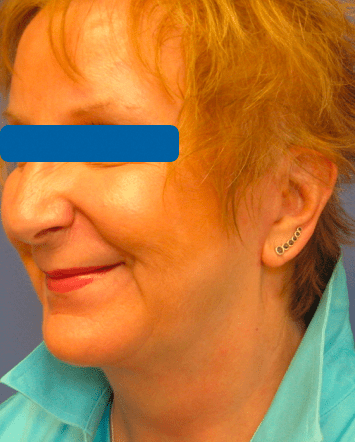 Facelift Before & After Patient #1720