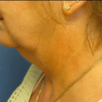 Facelift Before & After Patient #1720