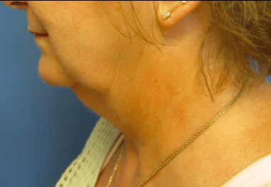Facelift Before & After Patient #1720